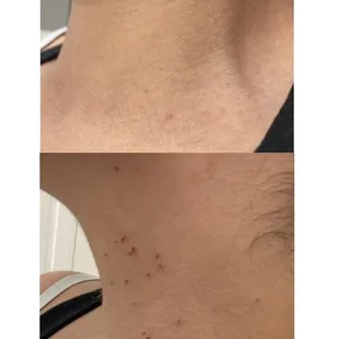 Skin tag removal