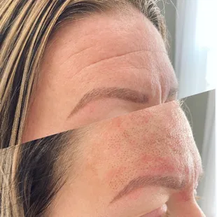 Forehead wrinkles diminished.