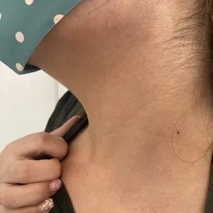 Skin tags all healed and gone! Super smooth skin!! Yay