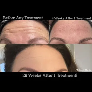 Real client results forehead
