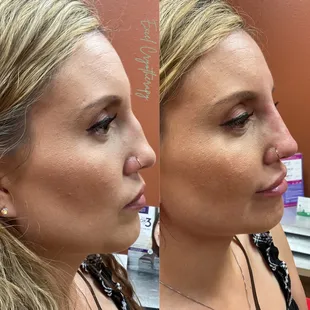 Liquid Rhinoplasty to straighten out Bridge of Nose.