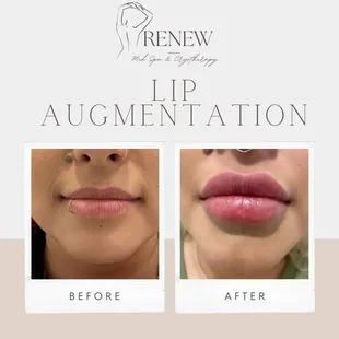 Lip Augmentation Before and After