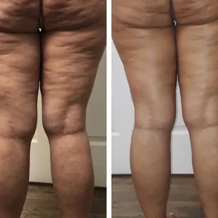 This unique body contouring treatment uses thermal shock to naturally kill fat cells and smooth out cellulite.