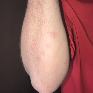 Bed bug bites