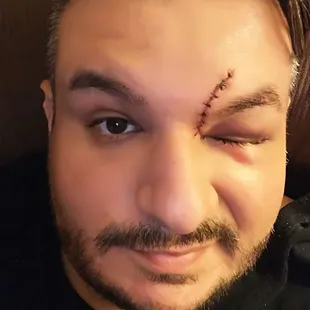 a man with stitches on his forehead