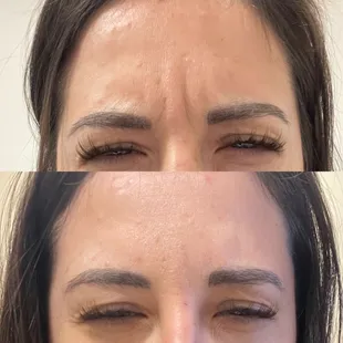 Treat those angry lines!