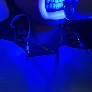 Getting teeth whitening by Shy!!