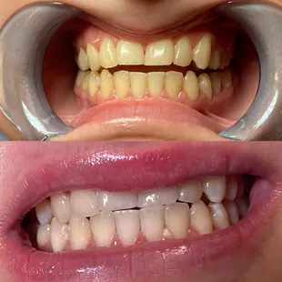 This after ONE session. Results will vary person to person depending on oral health and lifestyle. Message on Instagram for more details!