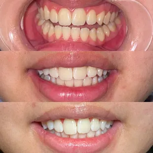 This client has been coming to me to maintain their white smile and keep it as white as the first time. Maintenance is key.