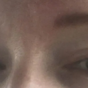 Day 4 the red went away, just a bit dark still,