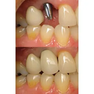 Dental Implants in Riverside