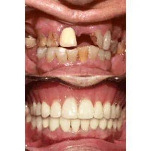 Dentures in Riverside