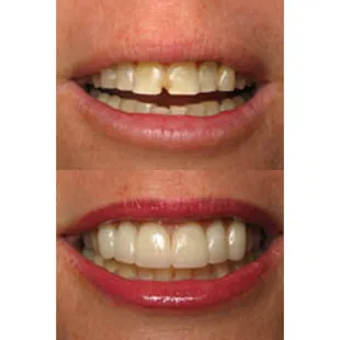 Veneers in Riverside
