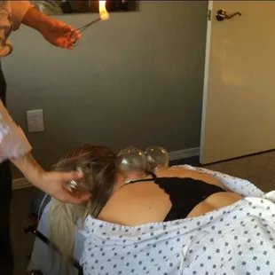 Chinese Cupping