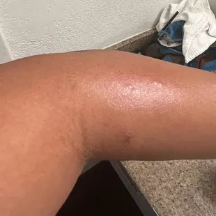 Bed bug bites on my arm