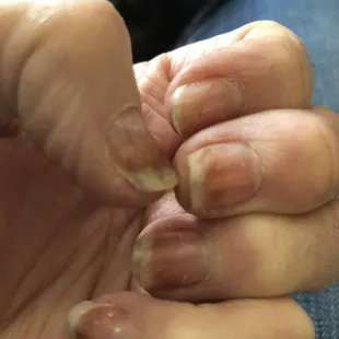 Nail bed infection