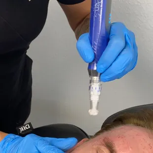 Microneedling with Skin Pen Plus
