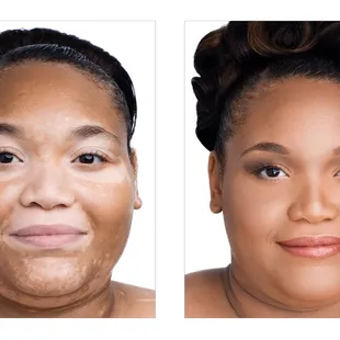 Vitiligo, Jane Iredale the Skin Care Makeup. Will cover.Products used: Amazing Base , and D2o hydration spray...
