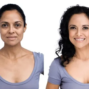 Under eye and dark circles, before and after