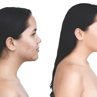 Acne scaring, before and after