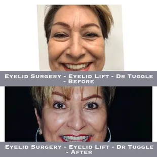 Eyelid Surgery - Eyelid Lift - Dr Tuggle - Before-After
