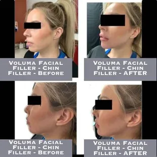 Voluma Facial Filler - Chin Filler - Before-After
