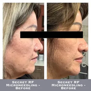 Secret RF Microneedling - Before-After