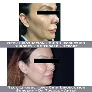 Liposuction - Chin Liposuction Surgery - Dr Tuggle - Before-After