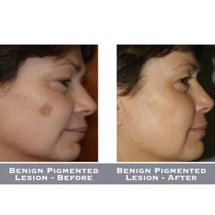 Benign Pigmented Lesion - Before-After