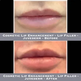 Cosmetic Lip Enhancement - Lip Filler - Juvederm - Before-After