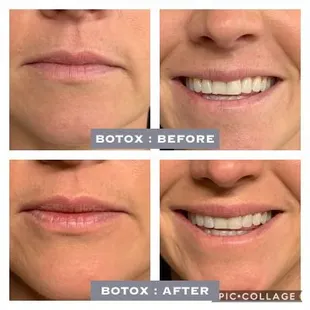 Botox Treatment : Before and After