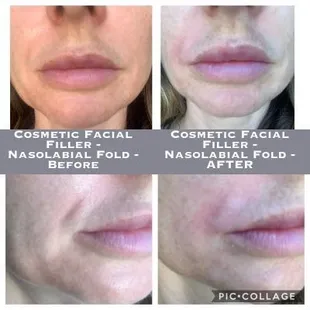 Cosmetic Facial Filler - Nasolabial Fold - Before-After