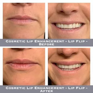 Cosmetic Lip Enhancement - Lip Flip - Before-After