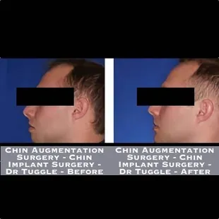 Chin Augmentation Surgery - Chin Implant Surgery - Dr Tuggle - Before-After