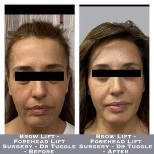 Brow Lift - Forehead Lift Surgery - Dr Tuggle - Before-After