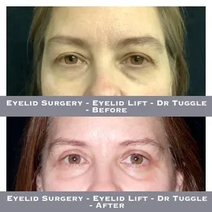 Eyelid Surgery - Eyelid Lift - Dr Tuggle - Before-After