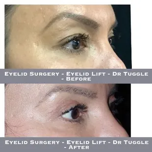 Eyelid Surgery - Eyelid Lift - Dr Tuggle - Before-After
