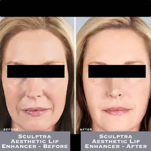Sculptra Aesthetic Lip Enhancer - Before-After