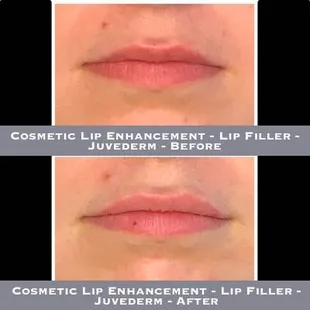 Cosmetic Lip Enhancement - Lip Filler - Juvederm - Before-After