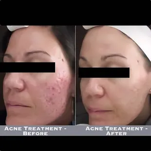 Acne Treatment - Before-After