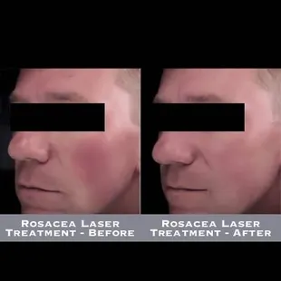Rosacea Laser Treatment - Before-After