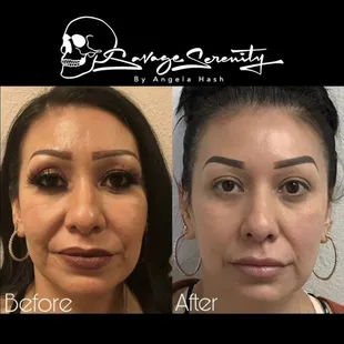 Full face rejuvenation with RHA filler.