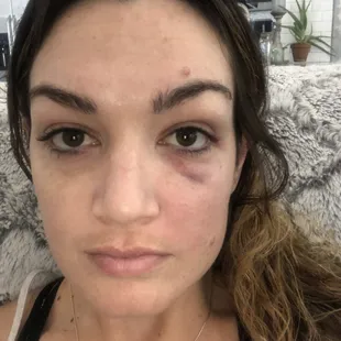 Black eye from being assaulted outside of Scarlet&apos;s Saloon in Folsom, where their management and security did nothing to help me.