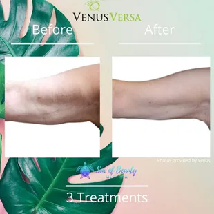 3 Sessions of Body Contouring.