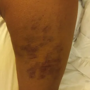 Bedbug bites on my girlfriends leg from our stay at the sea view hotel in Virginia Beach,  October 2nd 2021