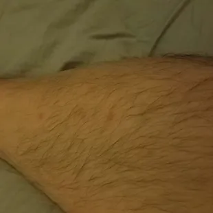Bedbug bites from the Good Old River Inn and Cabins (a few of ~50 total)