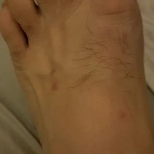 Bedbug bites from the Good Old River Inn and Cabins (a few of ~50 total)