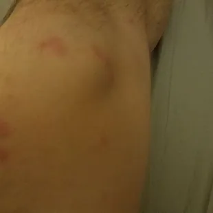 Bedbug bites from the Good Old River Inn and Cabins (a few of ~50 total)
