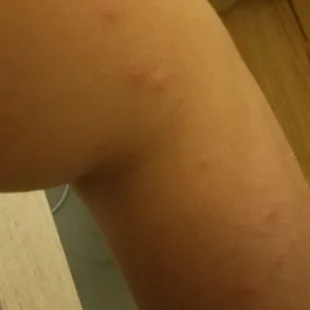 Bedbug bites from the Good Old River Inn and Cabins (a few of ~50 total)