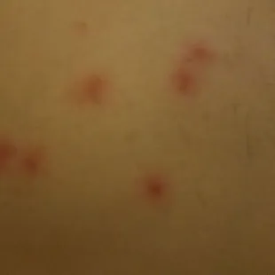 Bedbug bites from the Good Old River Inn and Cabins (a few of ~50 total)